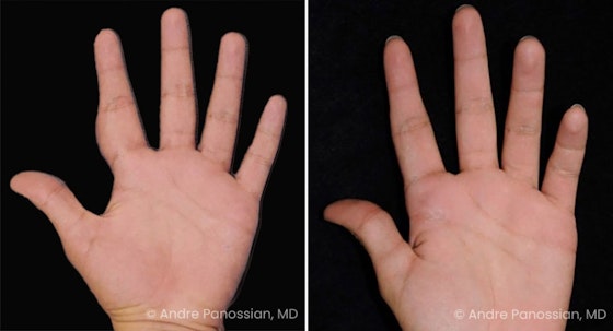 Neurofibroma removal & reconstruction before and after — actual patient of Andre Panossian, MD