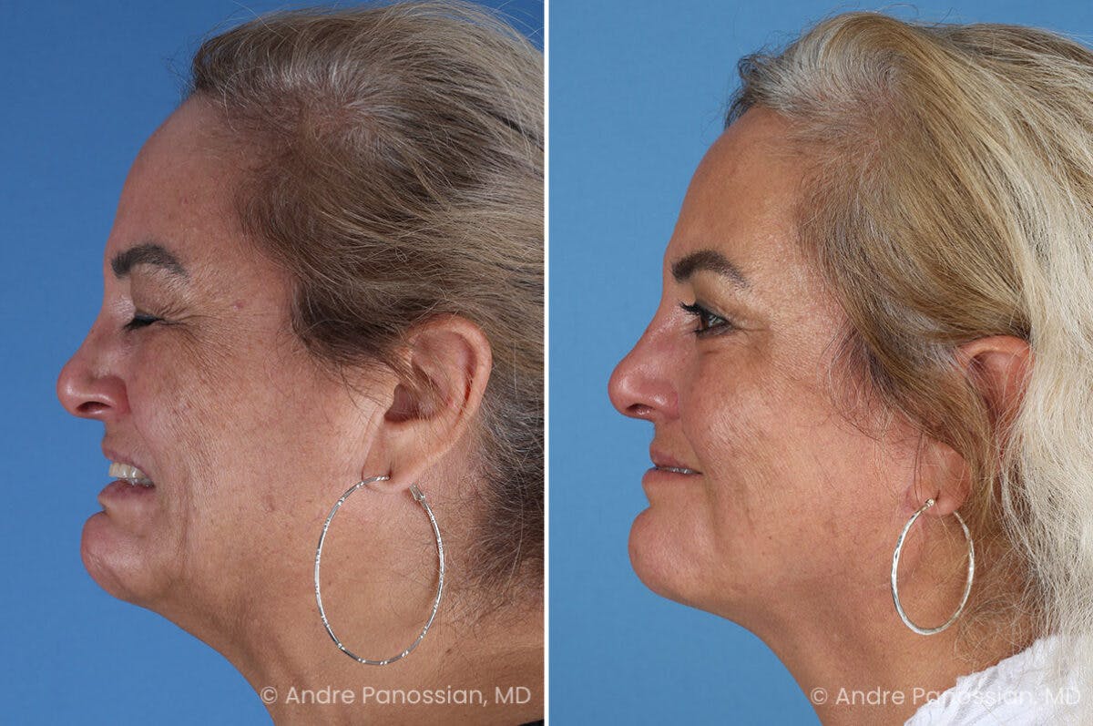 Selective Neurolysis Before & After Gallery - Patient 341804 - Image 11