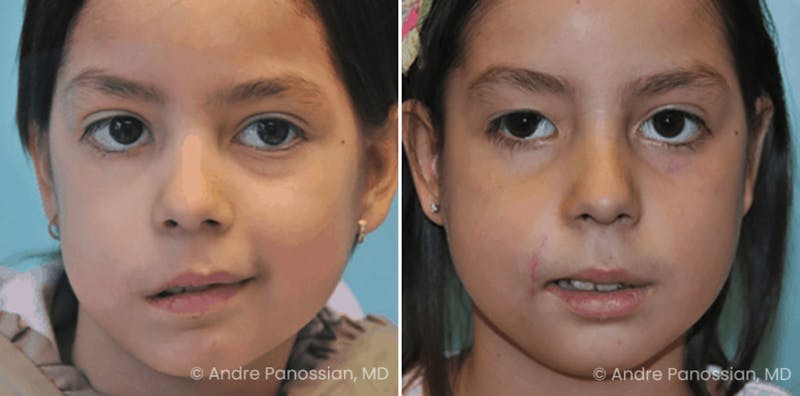 Smile Reanimation Before & After Gallery - Patient 202546 - Image 1