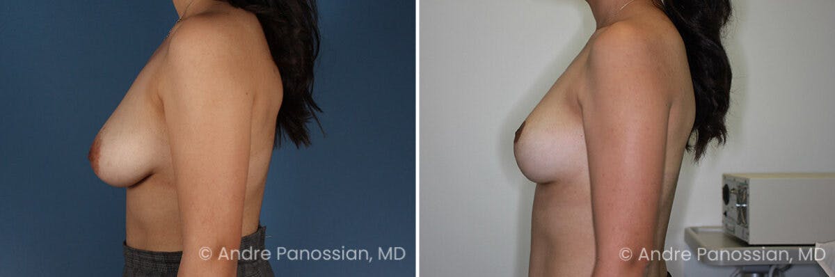 Breast Lift/Reduction Before & After Gallery - Patient 112349 - Image 5