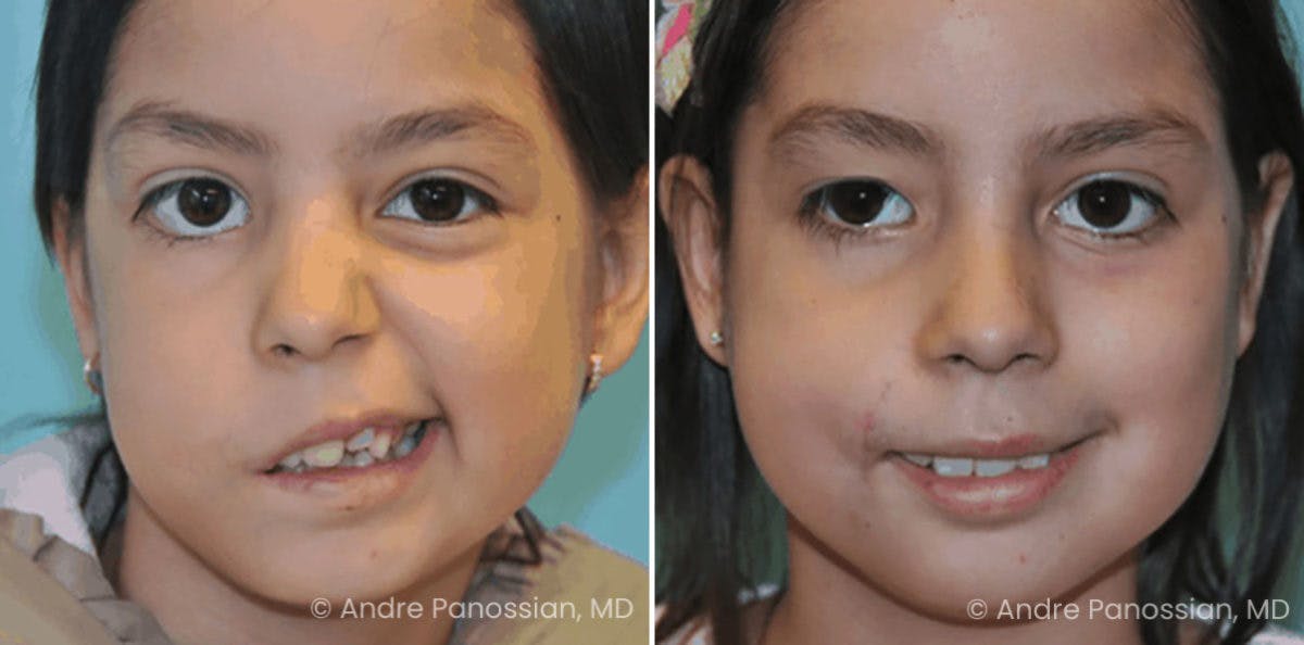 Smile Reanimation Before & After Gallery - Patient 202546 - Image 2