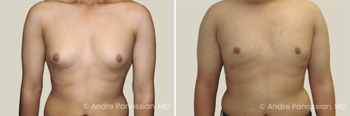 Male Breast Reduction (Gynecomastia) Before & After Gallery - Patient 239183 - Image 1
