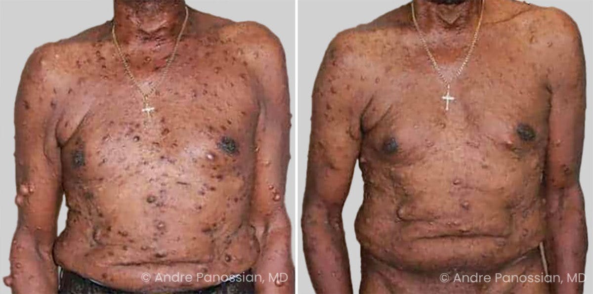 Neurofibromatosis Before & After Gallery - Patient 151736 - Image 1