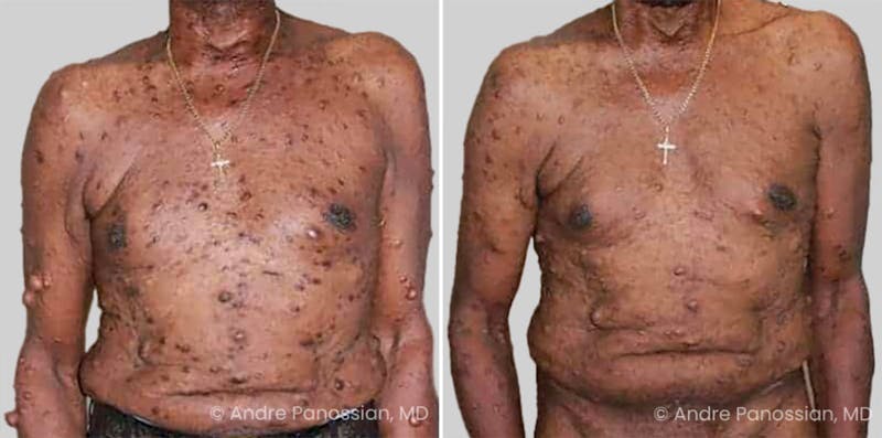 Neurofibromatosis Before & After Gallery - Patient 151736 - Image 1