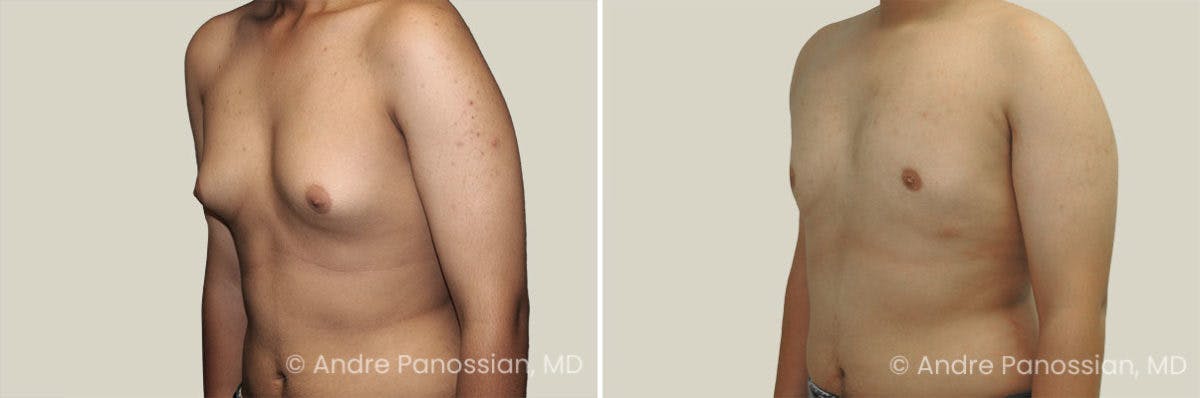 Male Breast Reduction (Gynecomastia) Before & After Gallery - Patient 239183 - Image 2