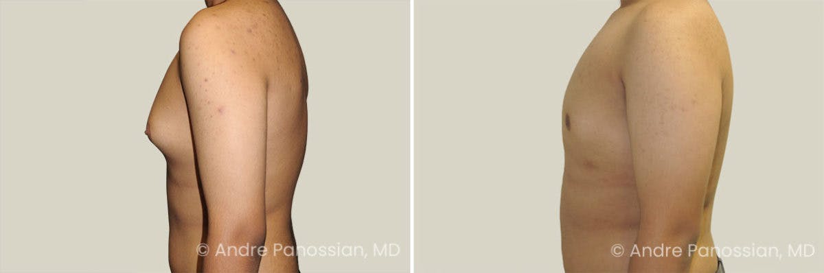 Male Breast Reduction (Gynecomastia) Before & After Gallery - Patient 239183 - Image 3