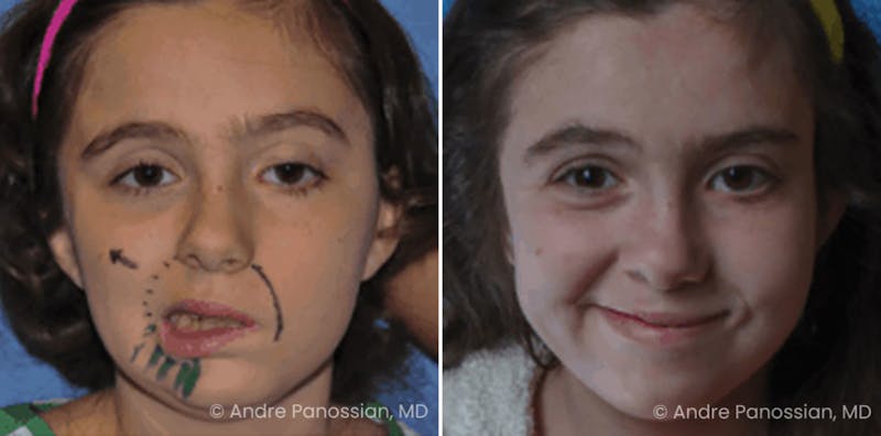 Smile Reanimation Before & After Gallery - Patient 300572 - Image 1