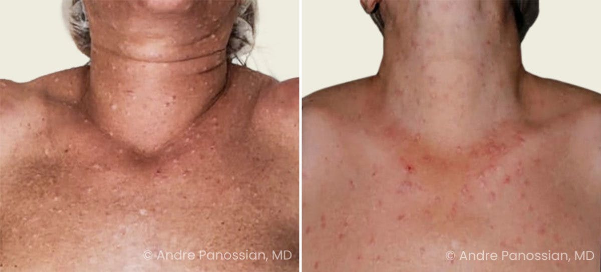 Neurofibromatosis Before & After Gallery - Patient 192916 - Image 1