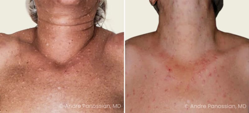 Neurofibromatosis Before & After Gallery - Patient 192916 - Image 1