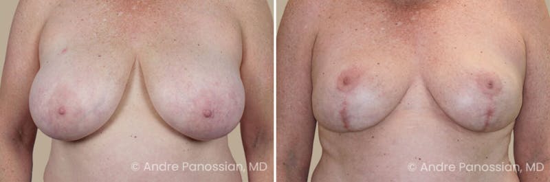 Breast Lift/Reduction Before & After Gallery - Patient 368581 - Image 1