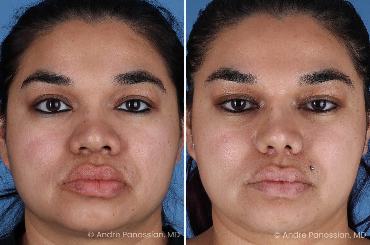 Rhinoplasty Before & After Gallery - Patient 399297 - Image 2