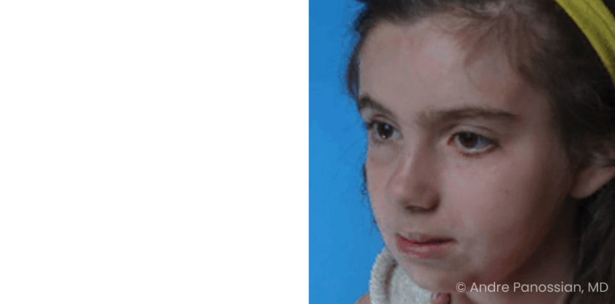 Smile Reanimation Before & After Gallery - Patient 300572 - Image 2