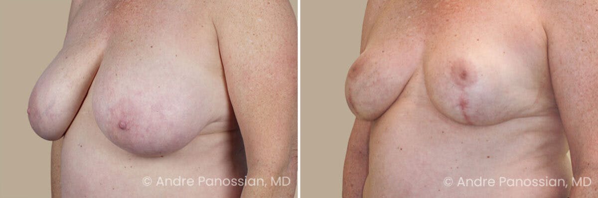 Breast Lift/Reduction Before & After Gallery - Patient 368581 - Image 2