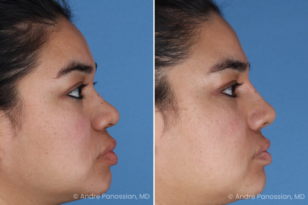 Rhinoplasty Before & After Gallery - Patient 399297 - Image 1