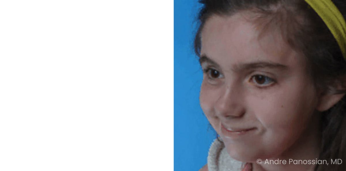Smile Reanimation Before & After Gallery - Patient 300572 - Image 3