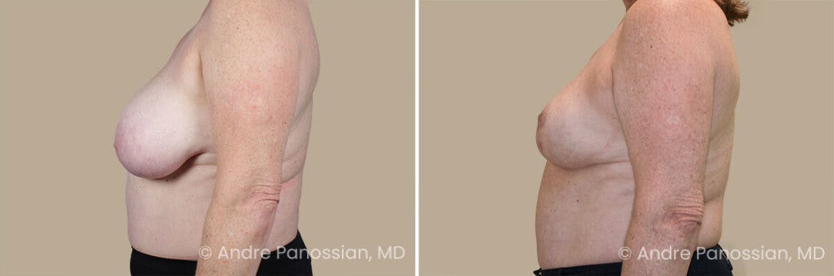 Breast Lift/Reduction Before & After Gallery - Patient 368581 - Image 3