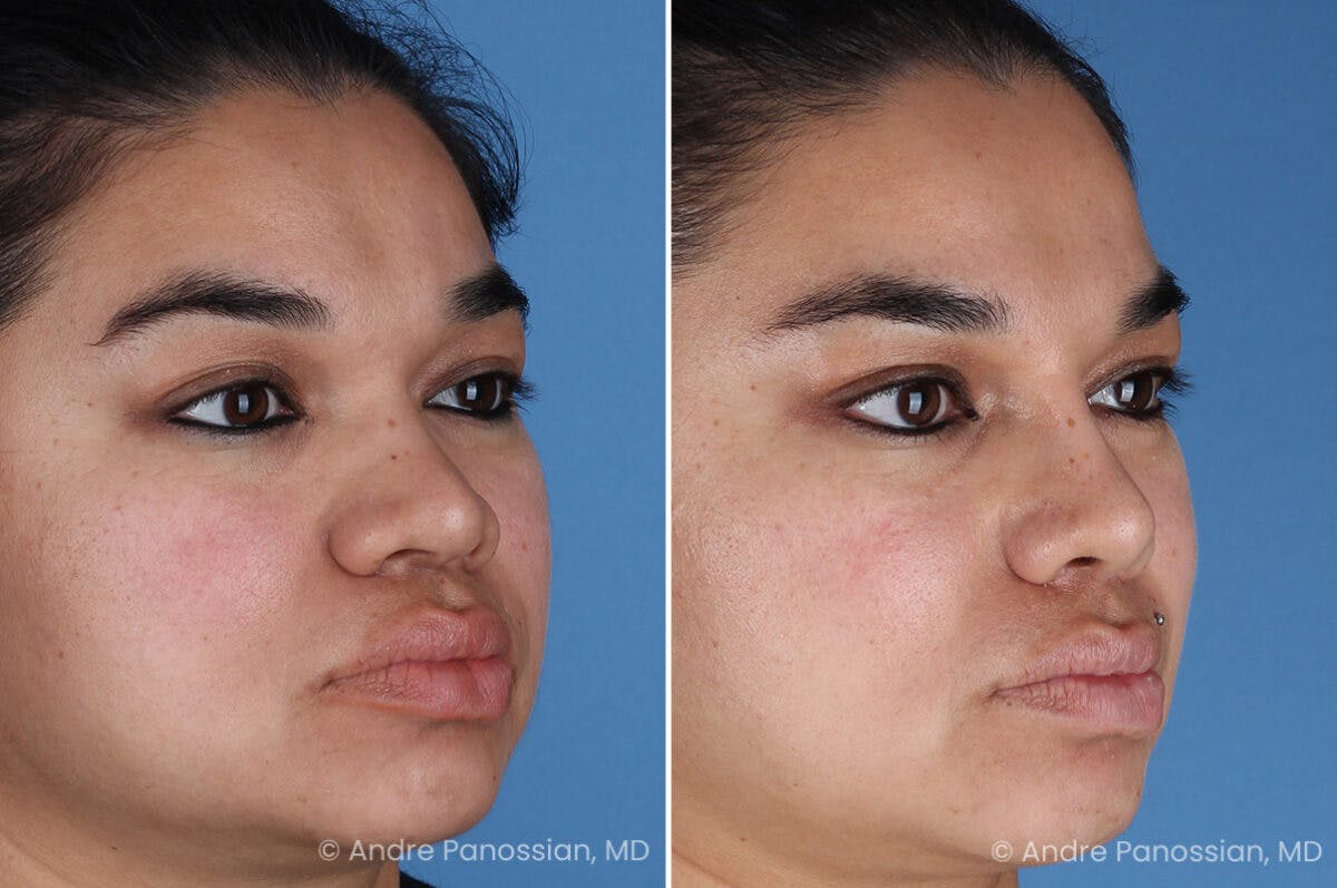 Rhinoplasty Before & After Gallery - Patient 399297 - Image 3