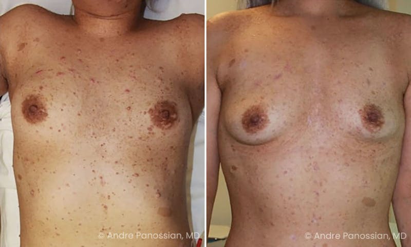 Neurofibromatosis Before & After Gallery - Patient 340134 - Image 1