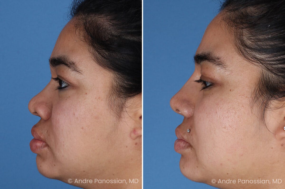 Rhinoplasty Before & After Gallery - Patient 399297 - Image 4