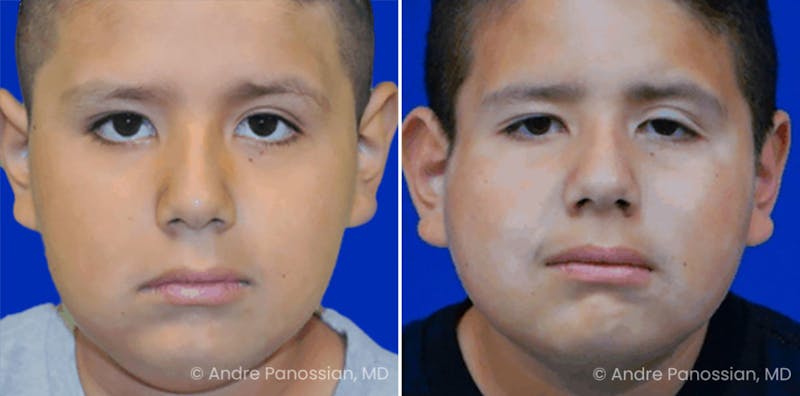 Smile Reanimation Before & After Gallery - Patient 314539 - Image 1