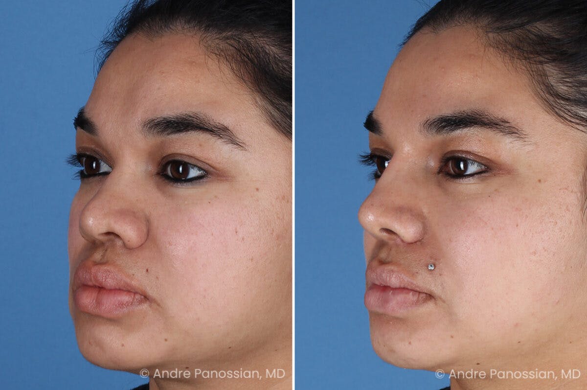 Rhinoplasty Before & After Gallery - Patient 399297 - Image 5