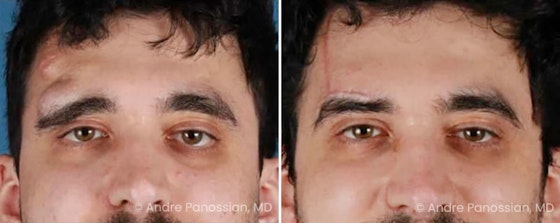 Neurofibroma removal & reconstruction before and after — actual patient of Andre Panossian, MD