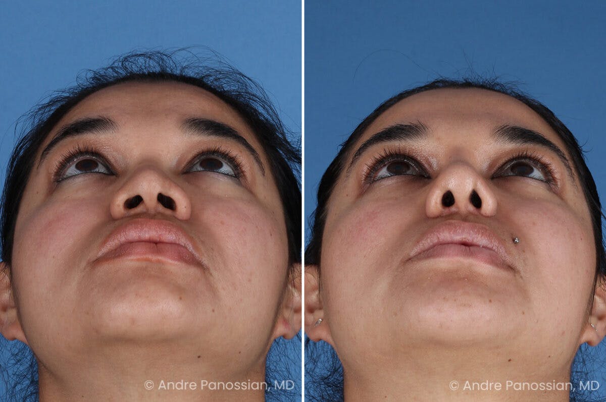 Rhinoplasty Before & After Gallery - Patient 399297 - Image 6