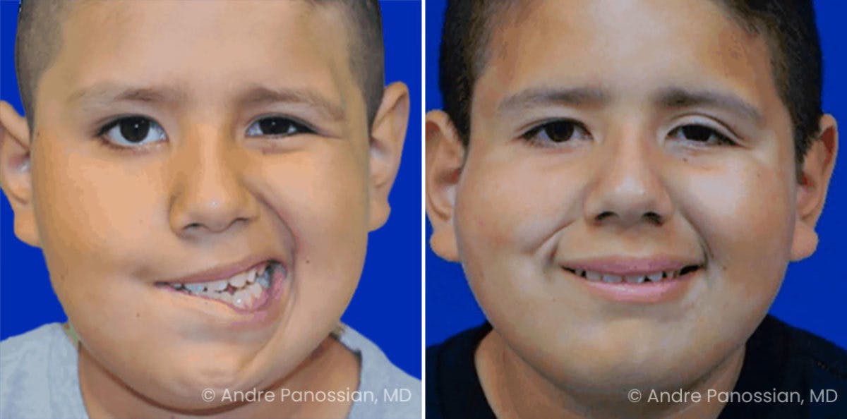 Smile Reanimation Before & After Gallery - Patient 314539 - Image 2