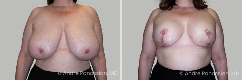 Breast Lift/Reduction Before & After Gallery - Patient 509962 - Image 1