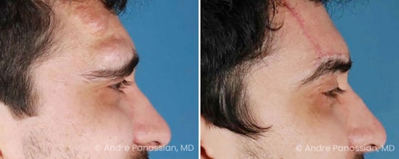 Neurofibroma removal & reconstruction before and after — actual patient of Andre Panossian, MD