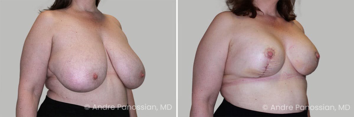 Breast Lift/Reduction Before & After Gallery - Patient 509962 - Image 2