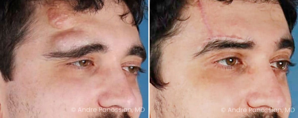 Neurofibromatosis Before & After Gallery - Patient 400031 - Image 3