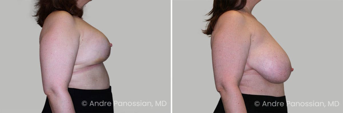 Breast Lift/Reduction Before & After Gallery - Patient 509962 - Image 3