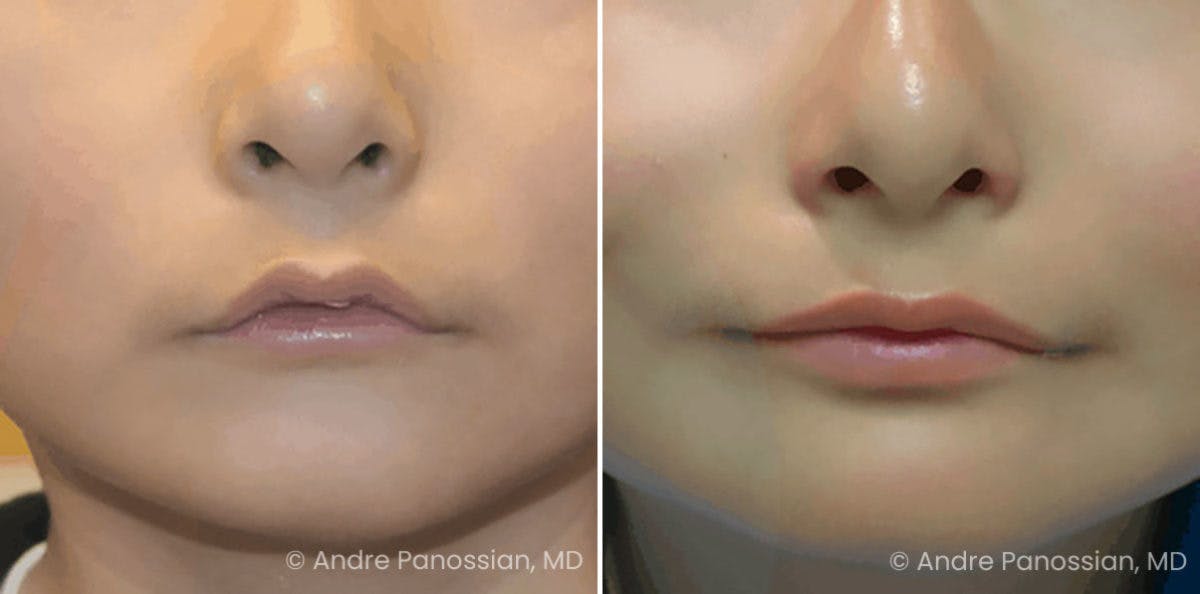 Smile Reanimation Before & After Gallery - Patient 357416 - Image 1