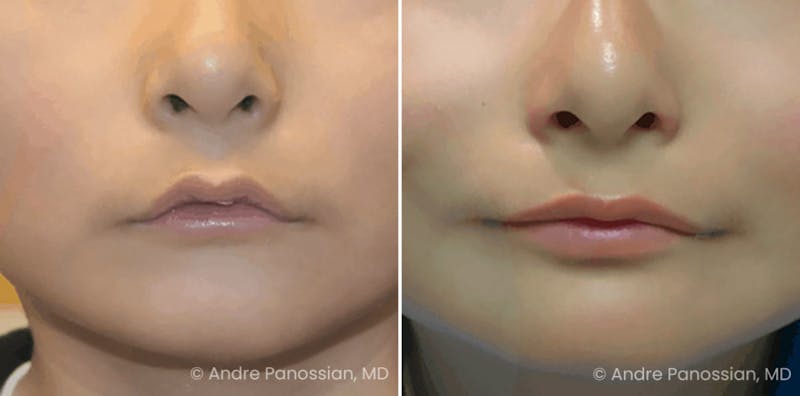 Smile Reanimation Before & After Gallery - Patient 357416 - Image 1