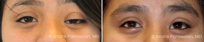 Neurofibromatosis Before & After Gallery - Patient 715310 - Image 1