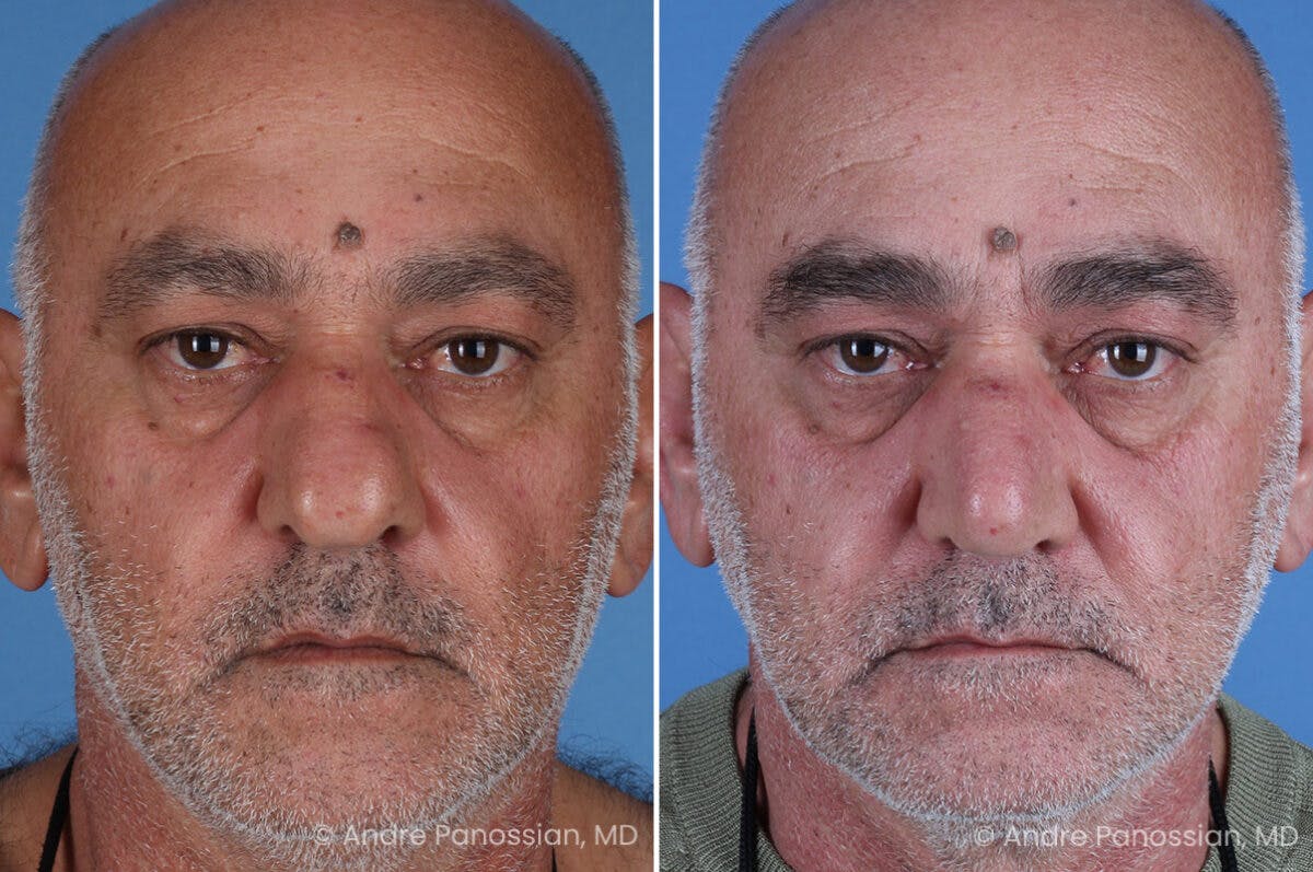 Rhinoplasty Before & After Gallery - Patient 202333 - Image 2