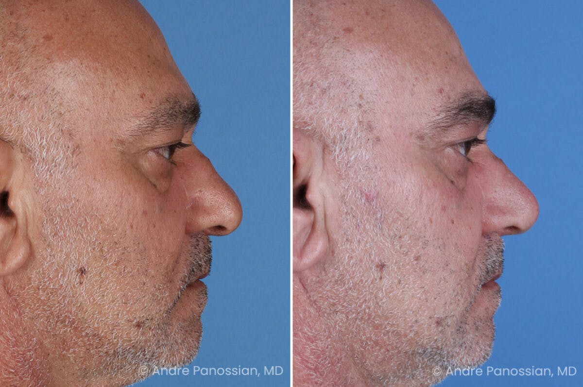 Rhinoplasty Before & After Gallery - Patient 202333 - Image 1