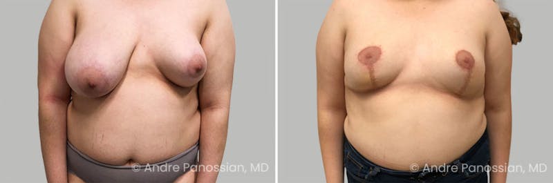 Breast Lift/Reduction Before & After Gallery - Patient 111708 - Image 1