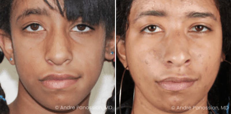 Smile Reanimation Before & After Gallery - Patient 389213 - Image 1