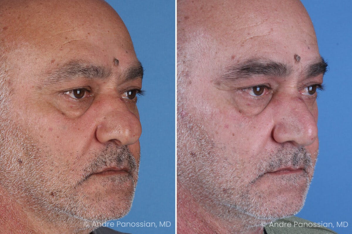 Rhinoplasty Before & After Gallery - Patient 202333 - Image 3