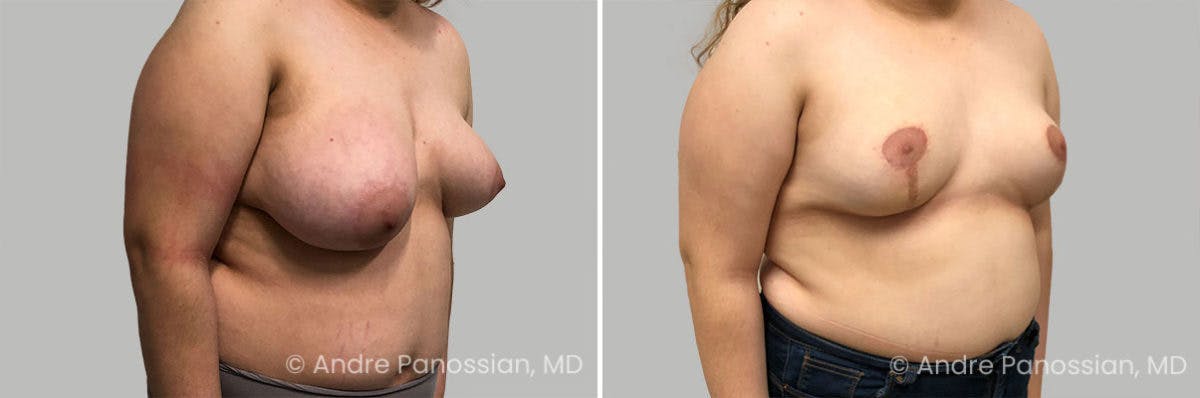 Breast Lift/Reduction Before & After Gallery - Patient 111708 - Image 2