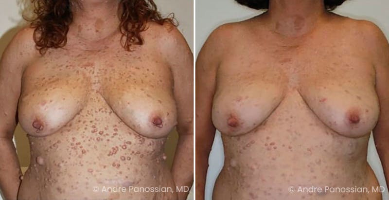 Neurofibromatosis Before & After Gallery - Patient 140740 - Image 1