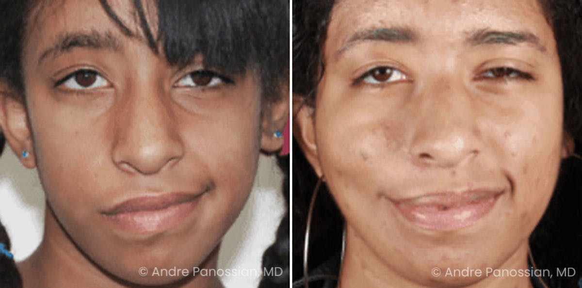 Smile Reanimation Before & After Gallery - Patient 389213 - Image 2