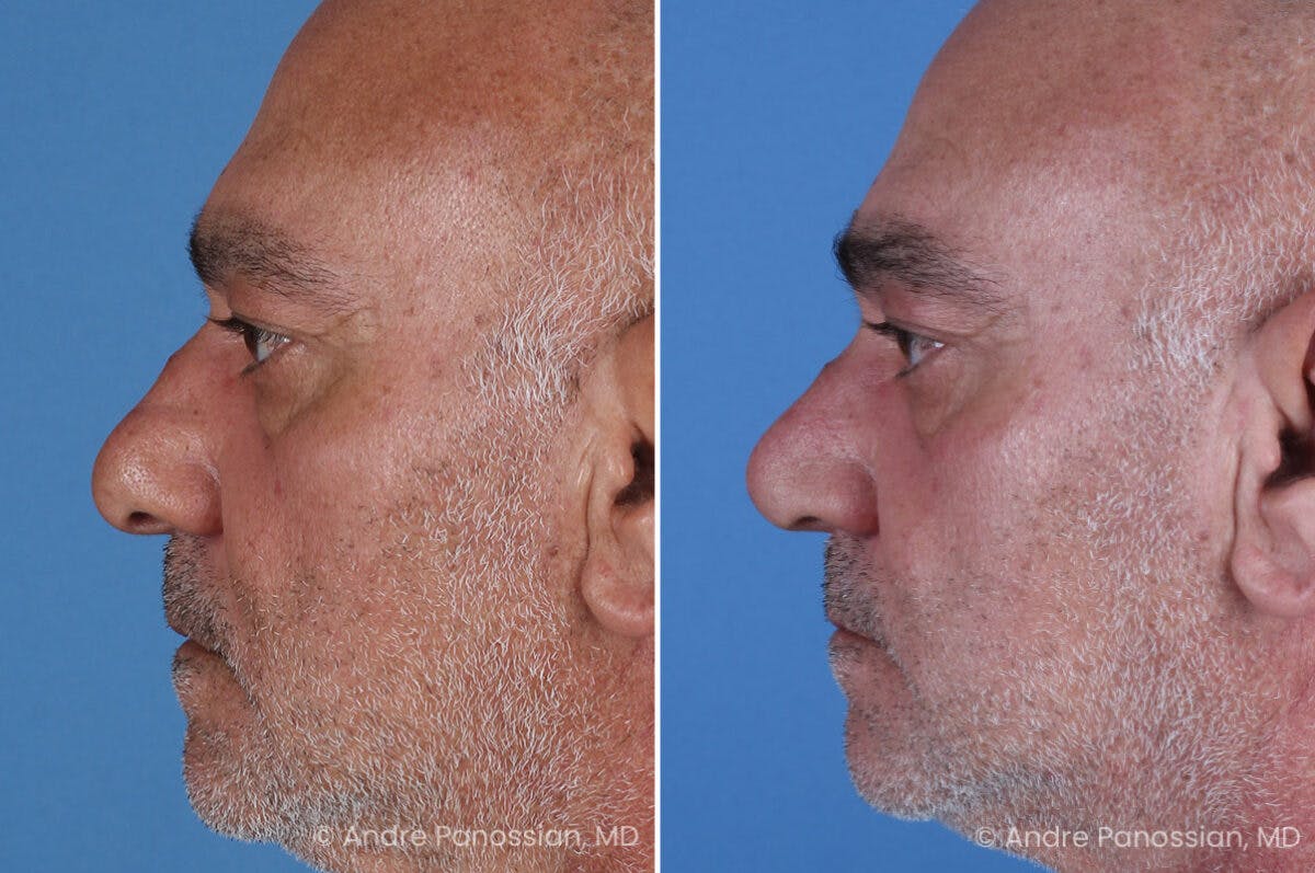 Rhinoplasty Before & After Gallery - Patient 202333 - Image 4