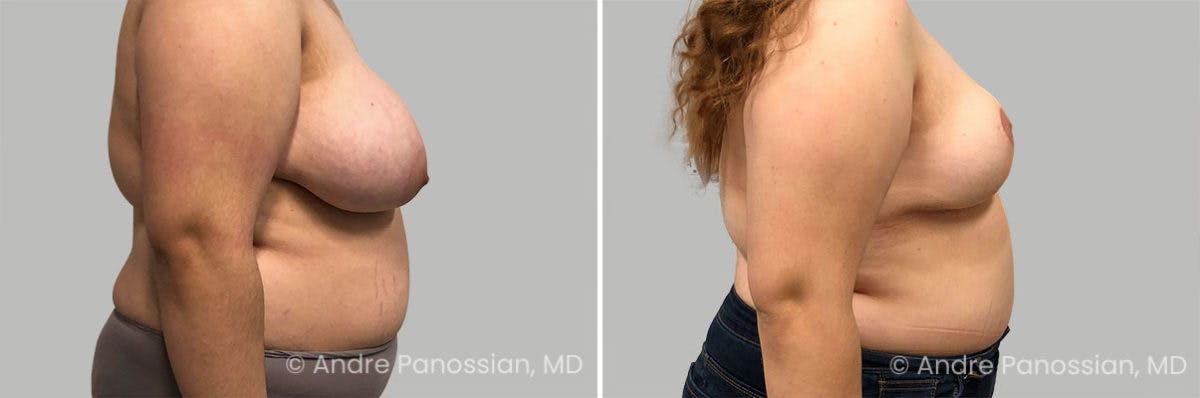 Breast Lift/Reduction Before & After Gallery - Patient 111708 - Image 3