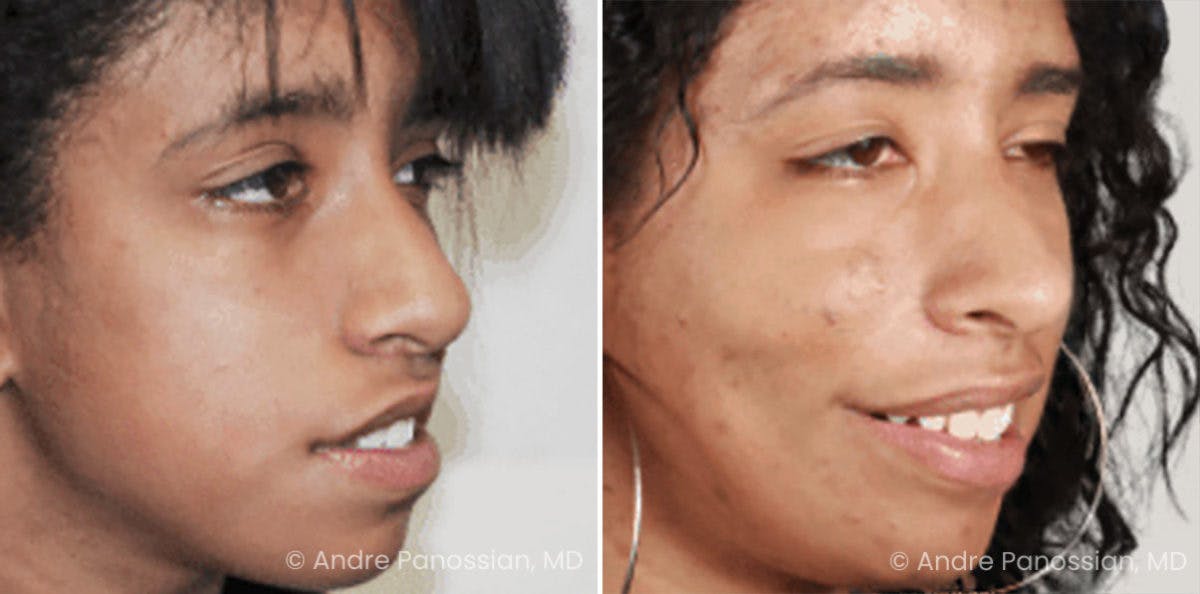 Smile Reanimation Before & After Gallery - Patient 389213 - Image 3