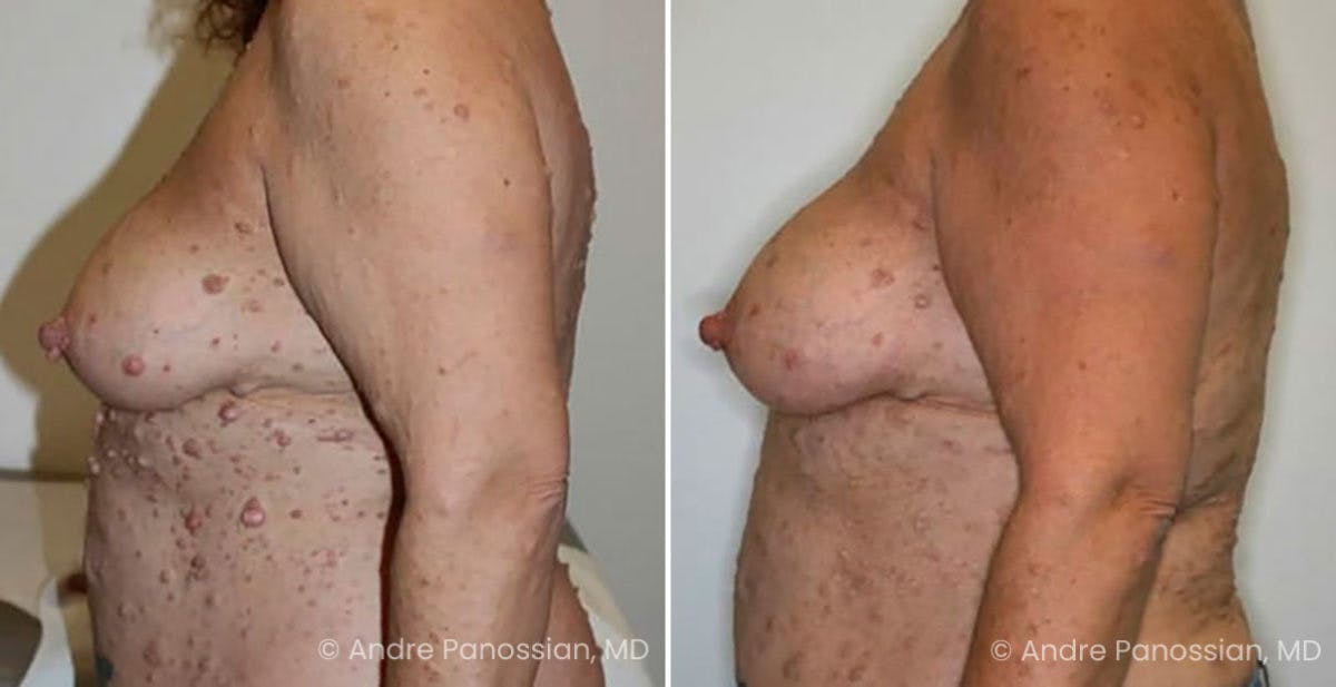 Neurofibromatosis Before & After Gallery - Patient 140740 - Image 2