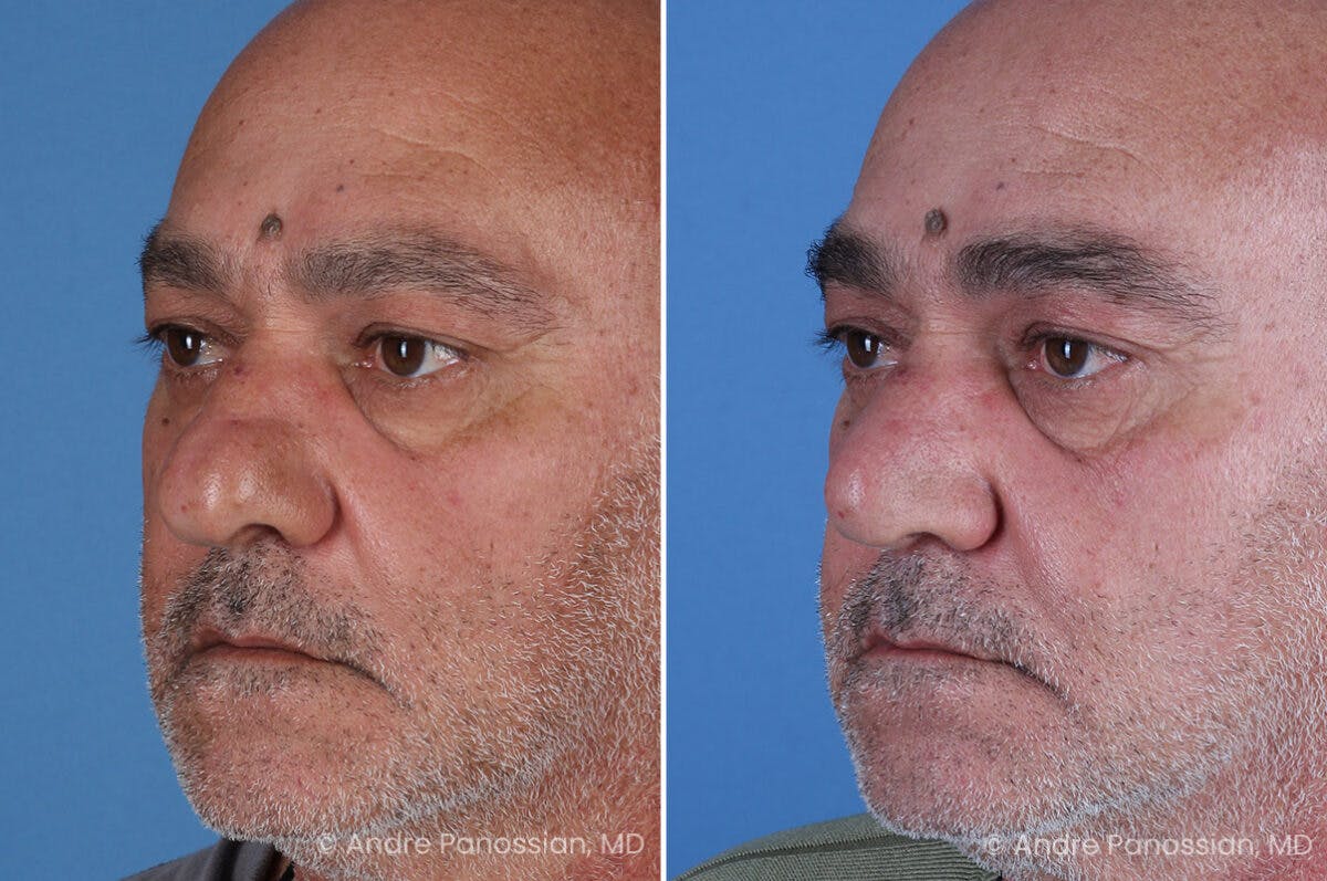 Rhinoplasty Before & After Gallery - Patient 202333 - Image 5