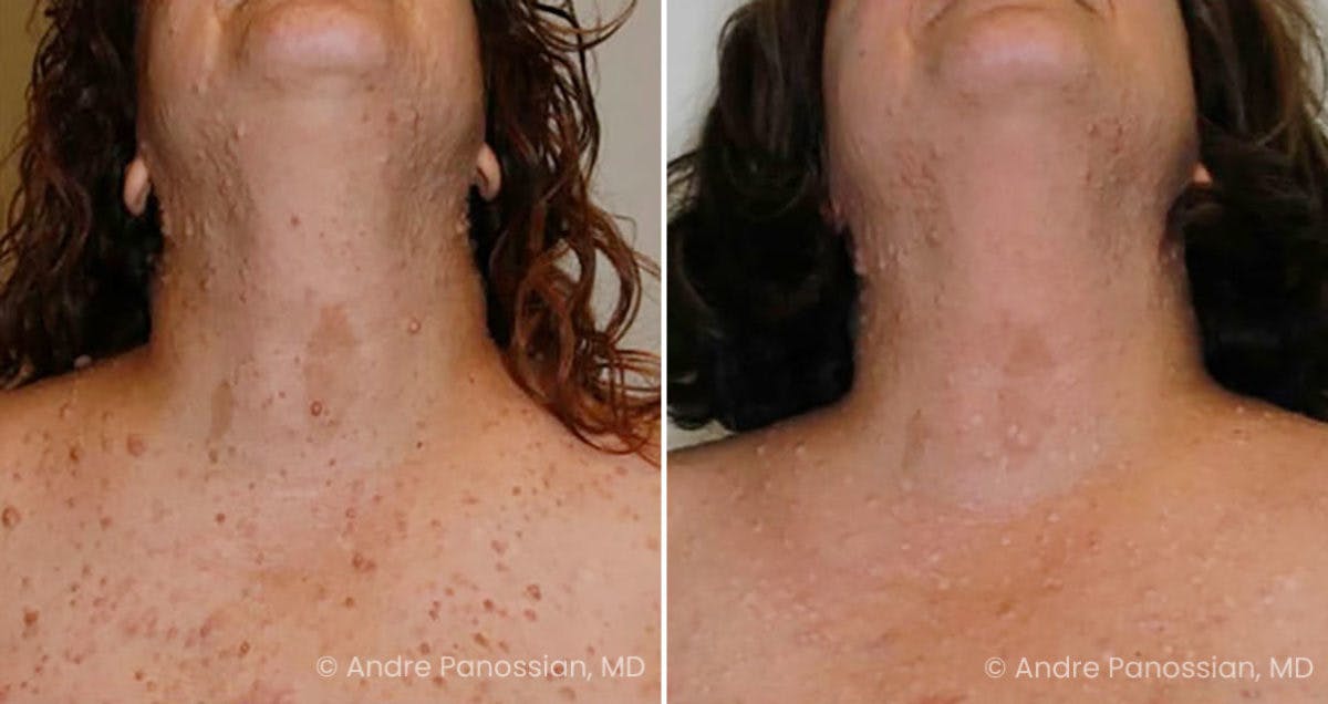 Neurofibromatosis Before & After Gallery - Patient 406106 - Image 1